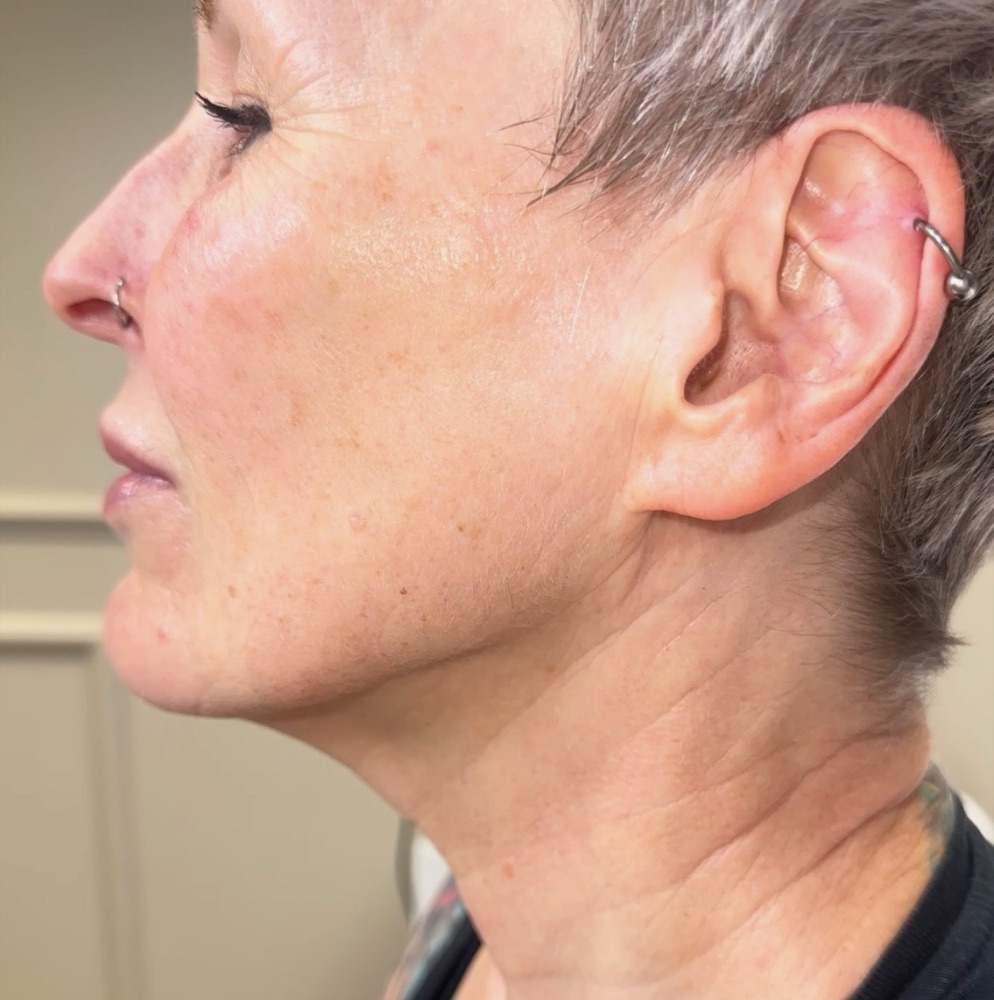 After treatment — tighter jawline and neck