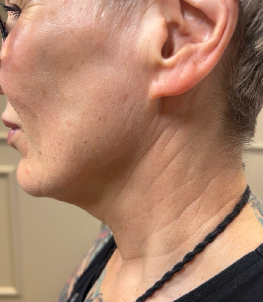 Before treatment — jawline and neck
