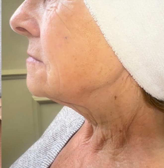 After treatment — smoother neck