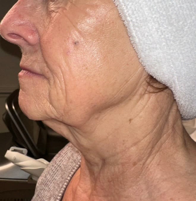 Before treatment — neck lines