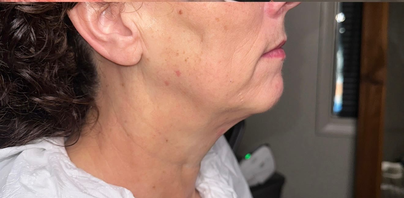 After treatment — defined jawline