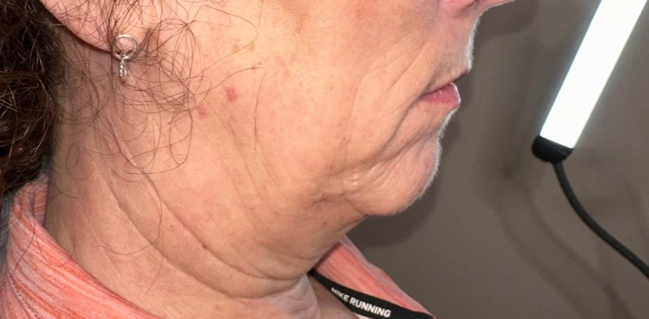 Before treatment — jowls and jawline