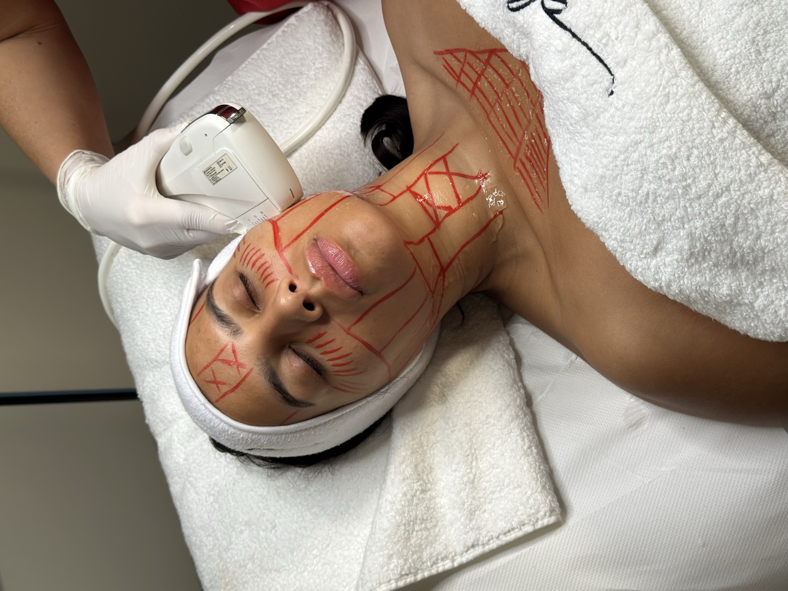 Facial mapping assessment during a HIFU treatment